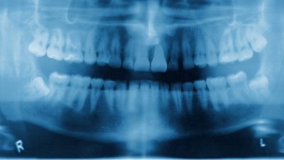 Британцы «вырывают себе зубы плоскогубцами», потому что не могут получить доступ к стоматологам.